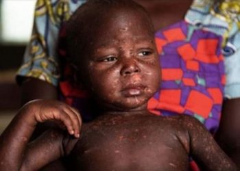 Rutshuru : 48 cas de rougeole dont 6 décès notifiés depuis janvier dans la zone de santé de Kibirizi