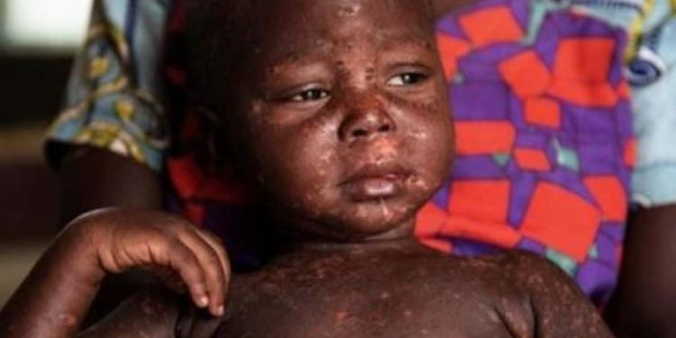 Rutshuru : 48 cas de rougeole dont 6 décès notifiés depuis janvier dans la zone de santé de Kibirizi