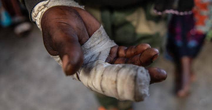 Rutshuru : un jeune présumé collaborateur d’un chef milicien blessé par balle par un élément de la Police près de Kibirizi