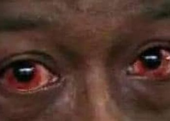 Nord-Kivu/Flambée des cas de la conjonctivite virale en la prison centrale de Butembo : l’antenne locale de la DPS rassure quant aux mesures de riposte