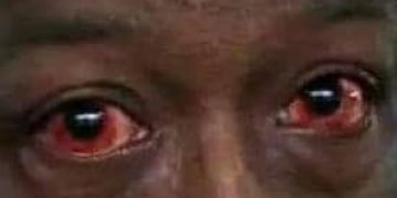 Nord-Kivu/Flambée des cas de la conjonctivite virale en la prison centrale de Butembo : l’antenne locale de la DPS rassure quant aux mesures de riposte