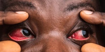 Nord-Kivu : plus de 160 cas de conjoctivite notifiés en la prison centrale de Beni