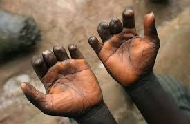 Prévention de la lèpre : docteur Mafuta insiste sur “le respect” du calendrier vaccinal chez les enfants