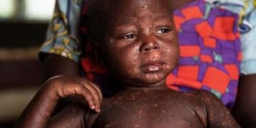 Nord-Kivu : nouvelle épidémie de rougeole dans la zone de santé de Rutshuru