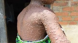 Nord-Kivu : un cas confirmé et trois suspects de Mpox signalés à Masisi