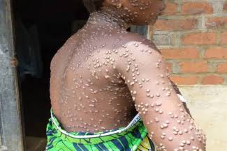 Nord-Kivu : un cas confirmé et trois suspects de Mpox signalés à Masisi