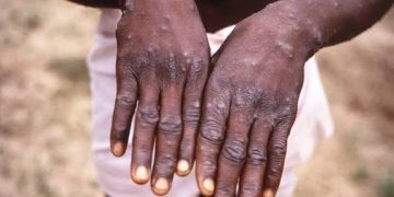 Maniema : dix cas suspects de Mpox découverts dans une chambre de prière à Lubutu